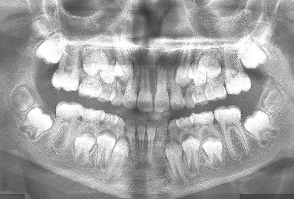 mixed-dentition-radiograph-ace-achievers